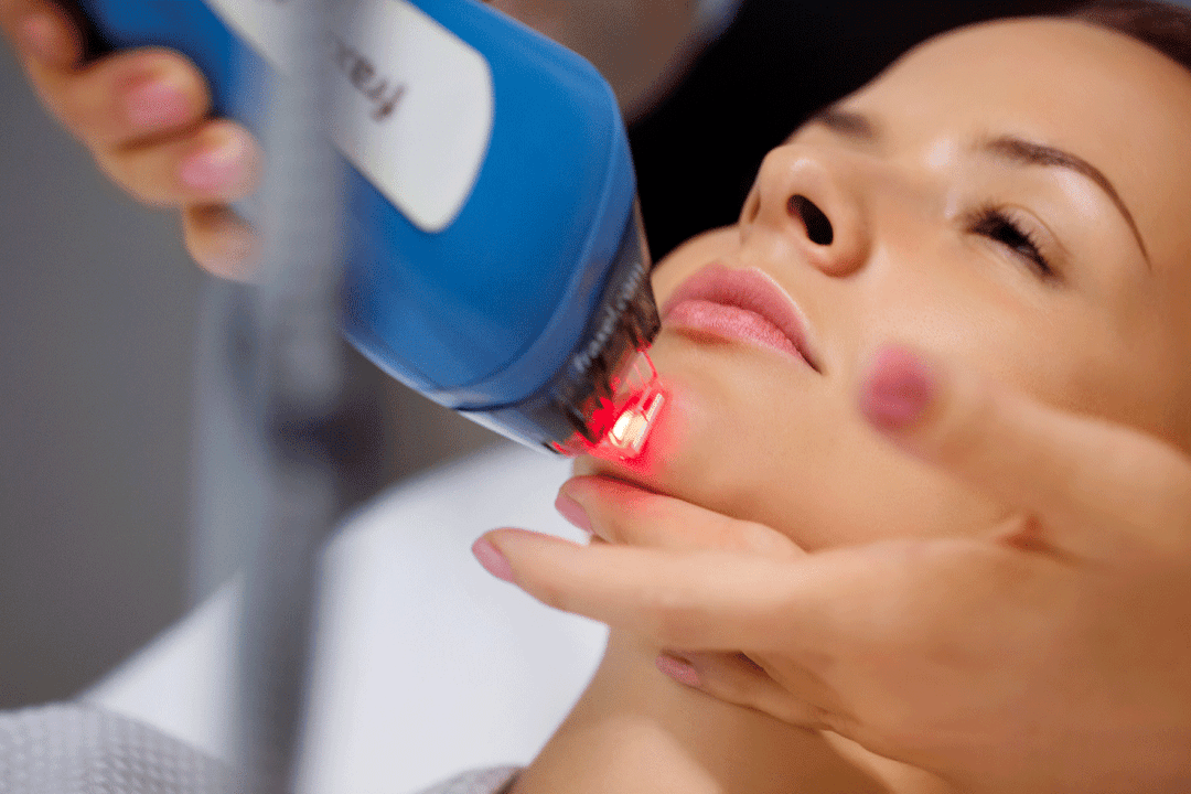 Ringiovanimento laser della pelle del viso