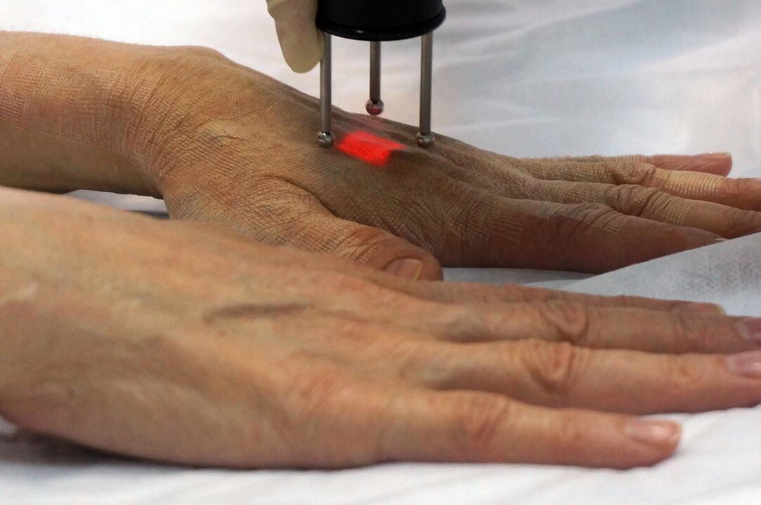Ringiovanimento laser delle mani con metodo non ablativo