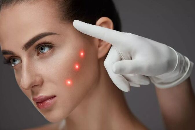 Ringiovanimento laser della pelle