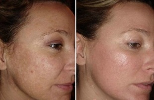 Ringiovanimento del viso laser prima e dopo le foto